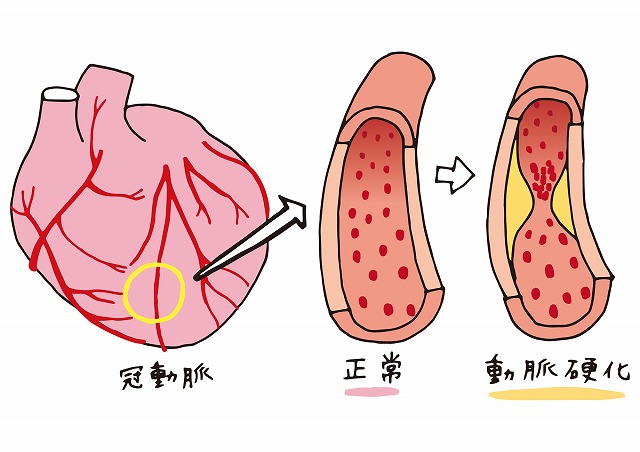 動脈硬化